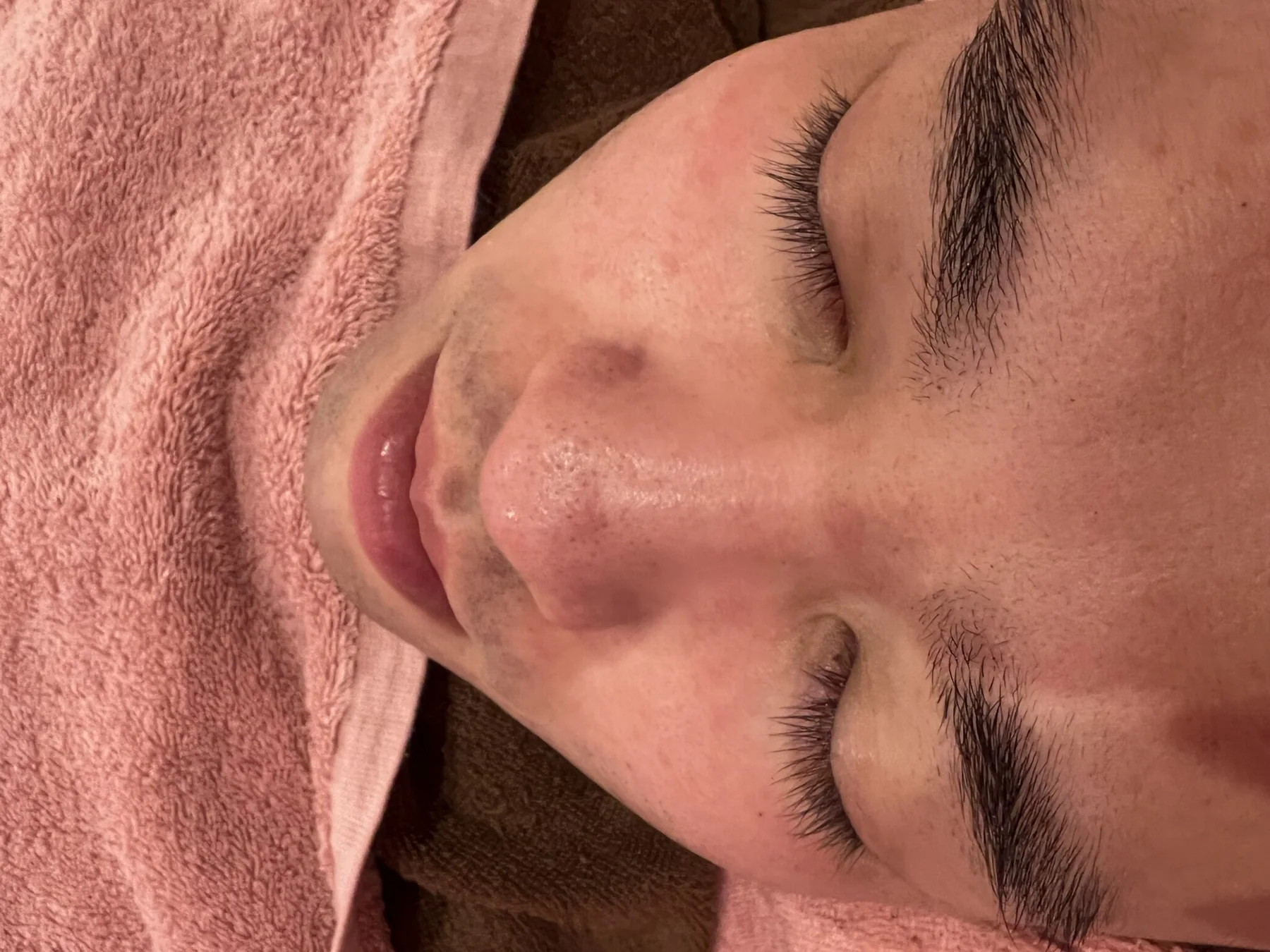 男性肌の肌管理例 ビフォー